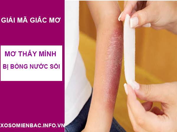 Nằm mơ thấy bị bỏng nước sôi là điềm báo gì? Đánh số mấy