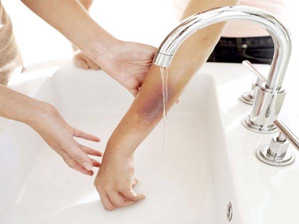 Nằm mơ thấy bị bỏng lửa – cơ hội hay rủi ro?